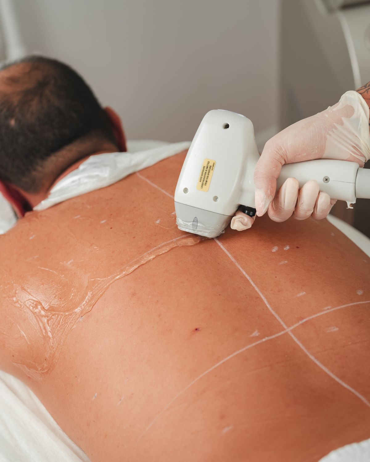 A laser hair removal session on a client's back at a clinic, technician holding the laser handpiece