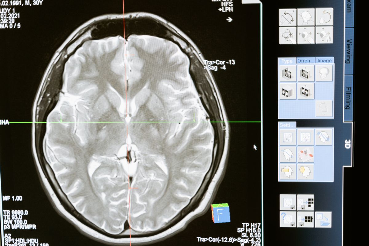 A brain scan on a diagnostic screen, the kind of clinical AI use patients want disclosed